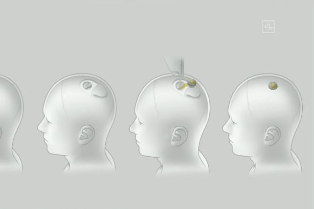 What the Brain Chips Would Look Like When Being Installed into a Human